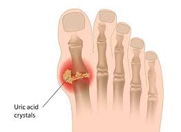 Uric Acid